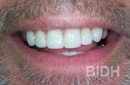 Smile After