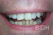 Smile Before