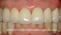 Dental Hospital Implant
