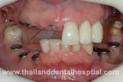 Dental Hospital Multiple Dental Implants