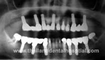 Dental Hospital Dental Implant Crown