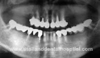Dental Implant Hospital X-ray