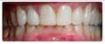Invisalign Case