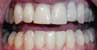 Invisalign Case