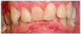 Invisalign