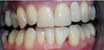 Invisalign Case