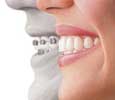 Invisalign Compare