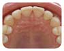 invisible braces after