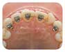 Braces
