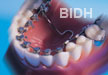 Lingual Braces