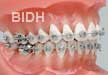 Metal Braces