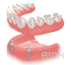 Implant Overdenture