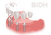 Dental Implant Bridge