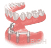Denture Implant