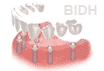 Dental Implants Bridge