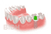 Dental implant