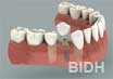 single implant