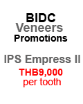 Veneers