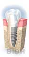 dental implant hospital