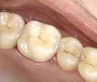 Cercon Zirconia
