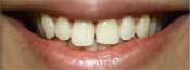 GlamSmile Veneer