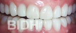 Veneers