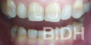 veneer case