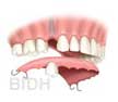 conventional implant