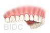One Day Implant