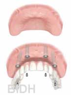 dental impalnt denture