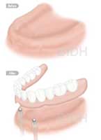 dental impalnt denture