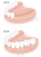 full arch dental implant