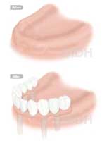 dental implant bridge