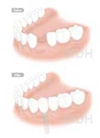 single dental implant