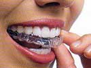 Invisalign