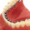 Lingual Braces