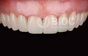 Porcelain Crowns and Veneers General Dentistry