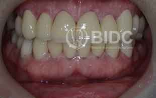 Crowns and Veneers General Dentistry