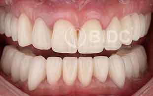 Porcelain Bridge Dental Implants