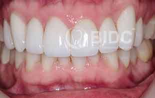 Shaping and Porcelain Veneers Prosthodontic Dentistry