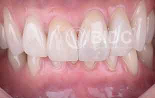 New Smile with Procelain Veneers Endodontic Dentistry