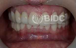 Porcelain Crowns Periodontic Dentistry