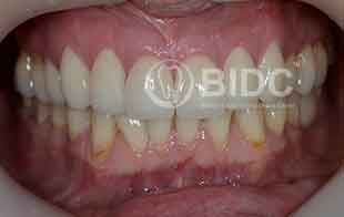 Composite Veneers Composite Veneers