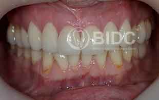 Composite Veneers