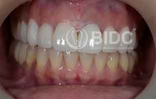 Gap Closing and Partial Dentures