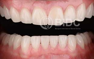 Dental Implants With Fixed Bridges Periodontic Dentistry