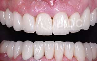 Dental Implants with Crowns Oral Surgery