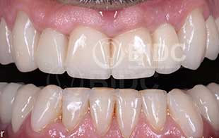 Dental Implants with Fixed Bridges Dental Implants with Fixed Bridges