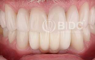 Full upper Arch Crowns and Veneers General Dentistry