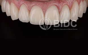 Full Mouth Veneers and Crowns, Gingivectomy Dental Implants